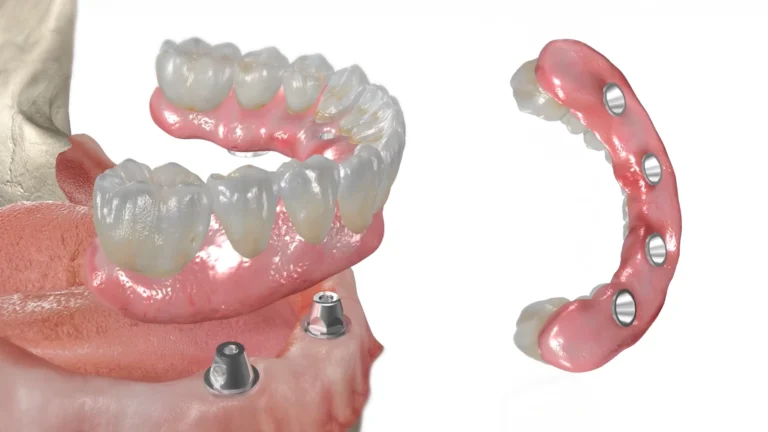 all on 4 animacija spajanja zubi na čeljust