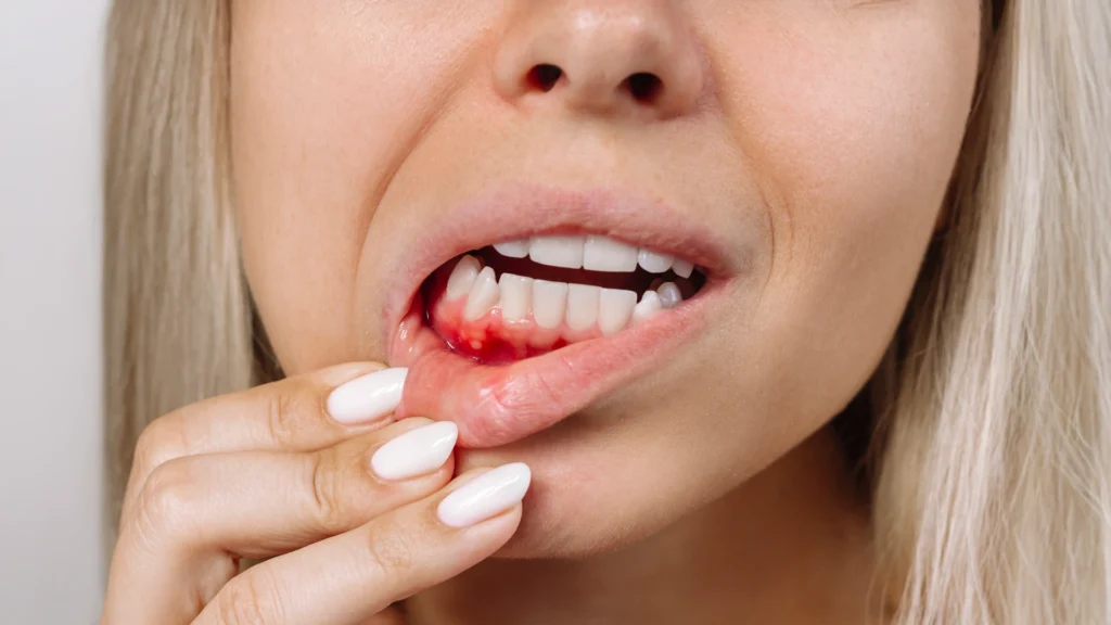 djevojka s otvorenim ustima pokazuje parodontozu na zubnom mesu
